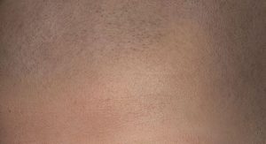 Micro haar pigmentatie bij alopecia areata of alopecia.