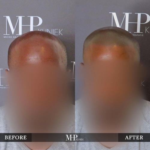 MHP-Micro-Haar-Pigmentatie-V29