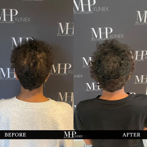 MHP-Micro-haar-pigmentatie-vrouwen-