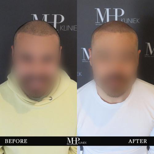 MHP-before-after-1