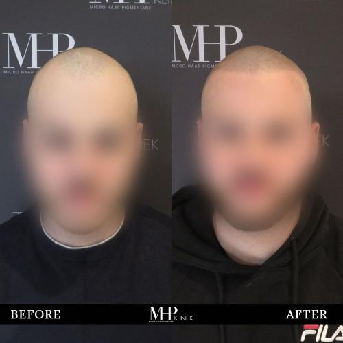 MHP-before-after-10