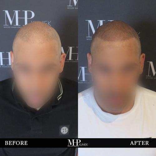 MHP-before-after-12