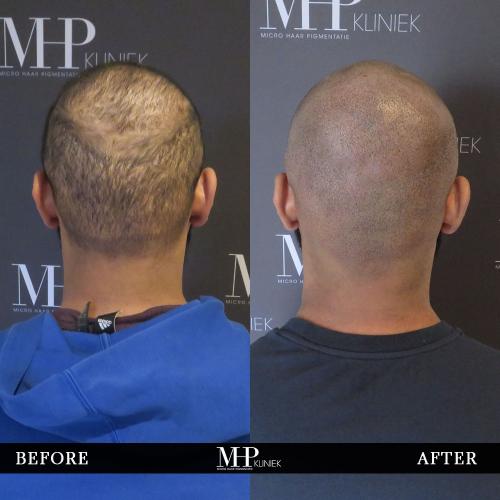 MHP-before-after-14