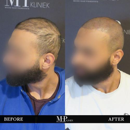 MHP-before-after-15