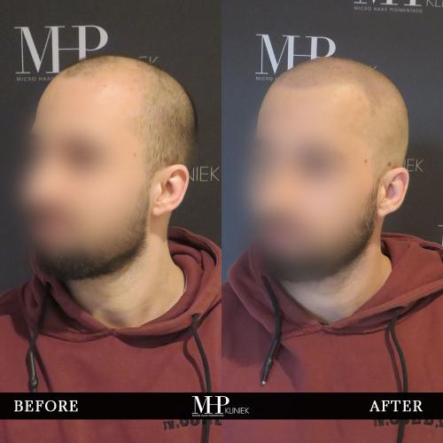 MHP-before-after-16