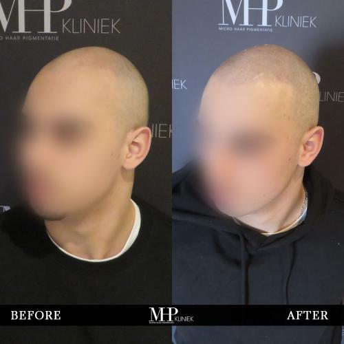 MHP-before-after-17