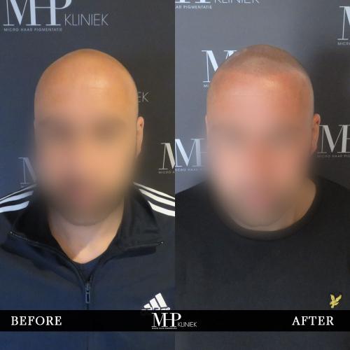 MHP-before-after-18
