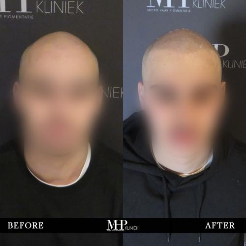 MHP-before-after-19