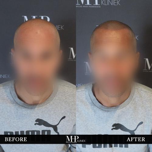 MHP-before-after-2