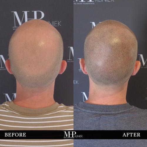 MHP-before-after-20