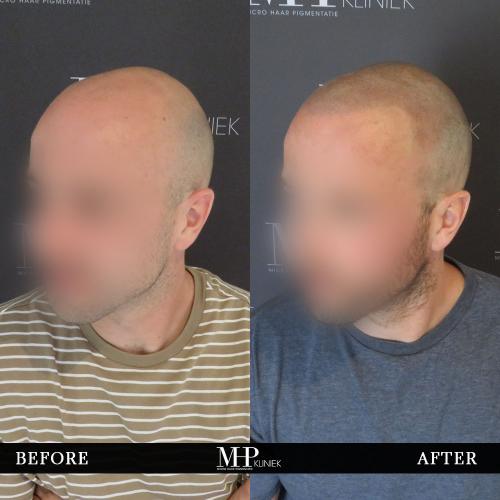 MHP-before-after-21