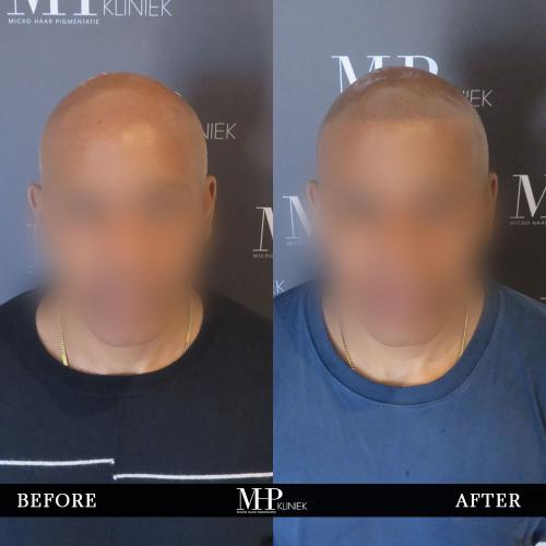MHP-before-after-22