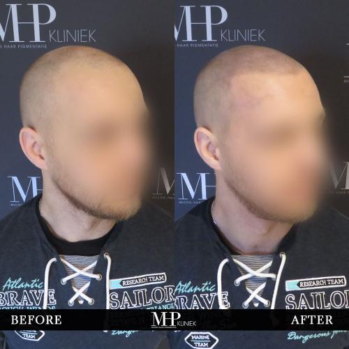 MHP-before-after-23