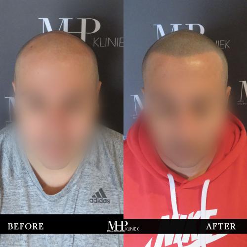 MHP-before-after-24