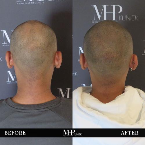 MHP-before-after-25