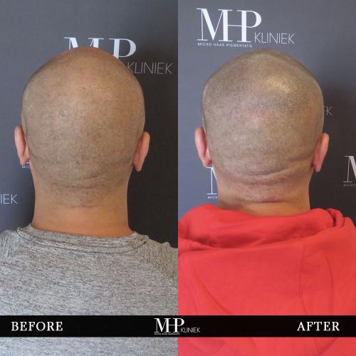 MHP-before-after-26