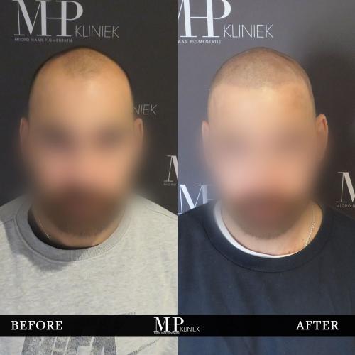 MHP-before-after-27
