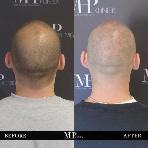 MHP-before-after-29