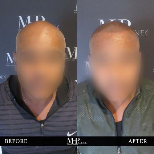 MHP-before-after-30