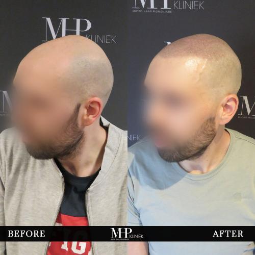 MHP-before-after-31
