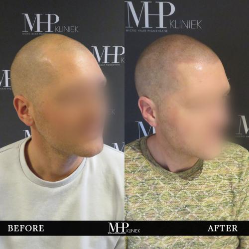 MHP-before-after-32