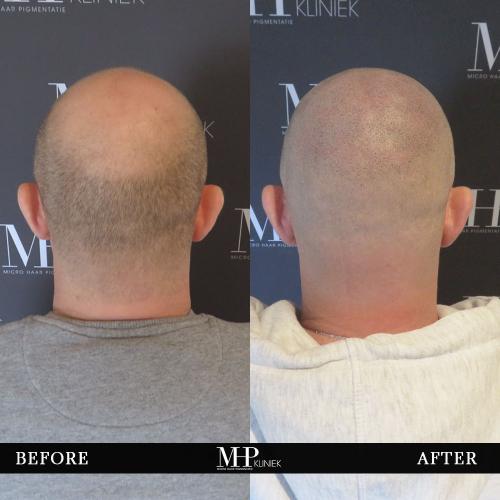 MHP-before-after-33