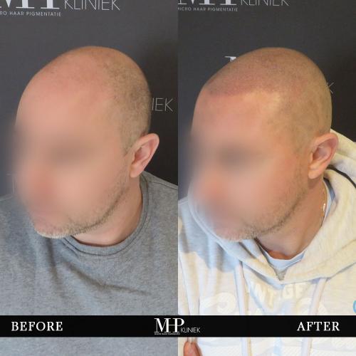 MHP-before-after-34