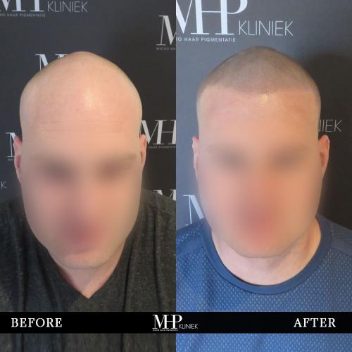 MHP-before-after-35