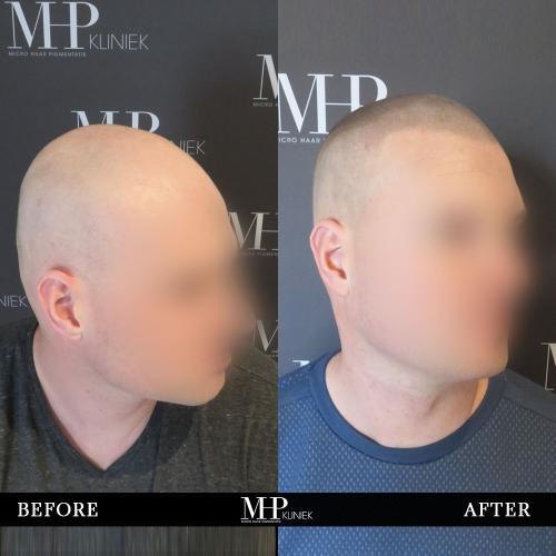 MHP-before-after-36