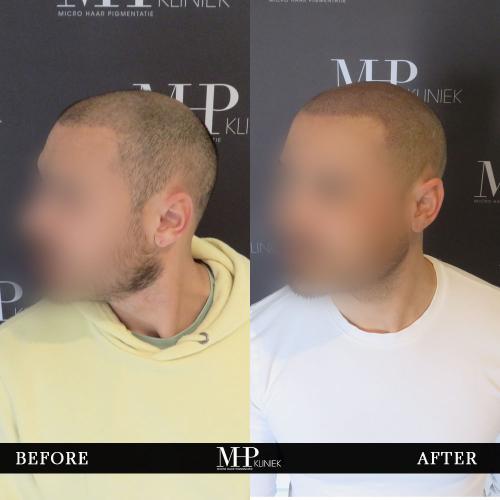 MHP-before-after-4