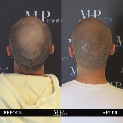 MHP-before-after-5