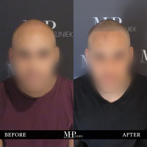MHP-before-after-7