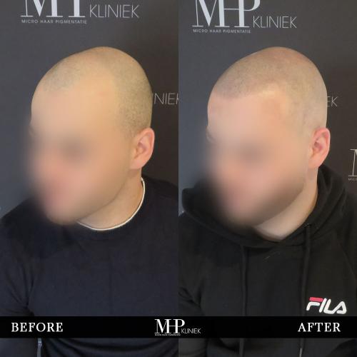 MHP-before-after-9